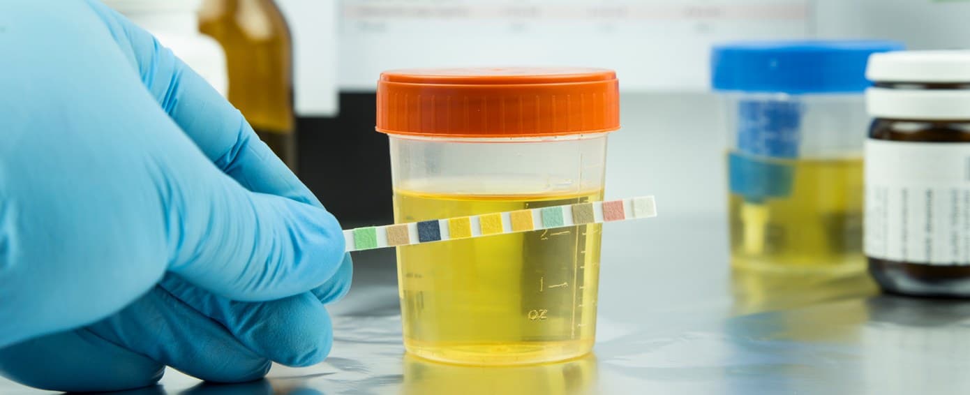Gloved hand holding a test strip beside specimen cups